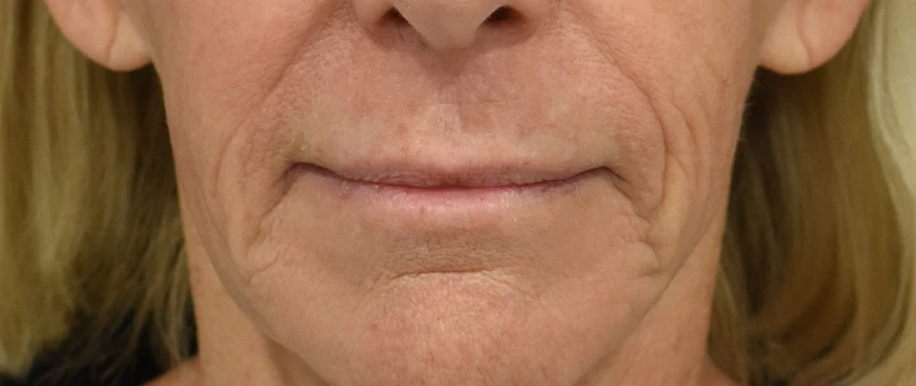 Lip Lift Patient 13 Set 1 Before