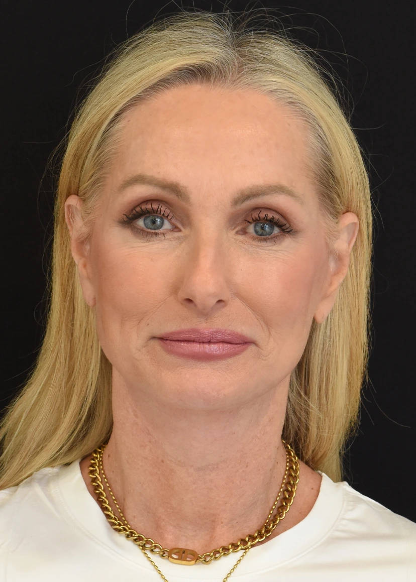Deep Plane Facelift Patient 27 Set 1 After