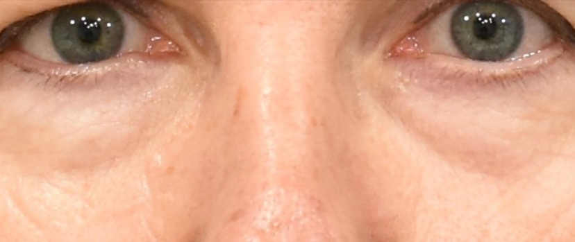 Brow Lift Patient 2 Set 1 Before