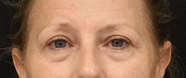 Eyelid Surgery Patient 22 Set 1 Before