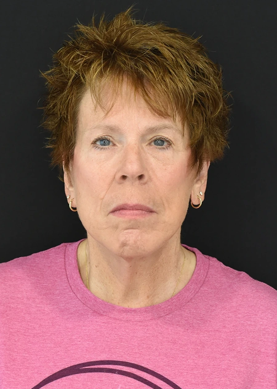 Extended Deep Plane Facelift Patient 13 Set 1